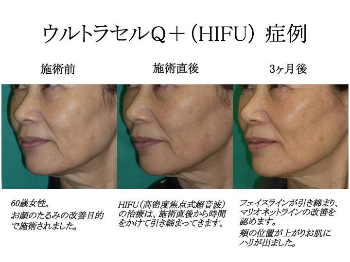 たるみ しわ 輪郭の治療 女性クリニック We Toyama 乳腺外科 形成美容外科 婦人科 不妊外来 各種女性検診 富山